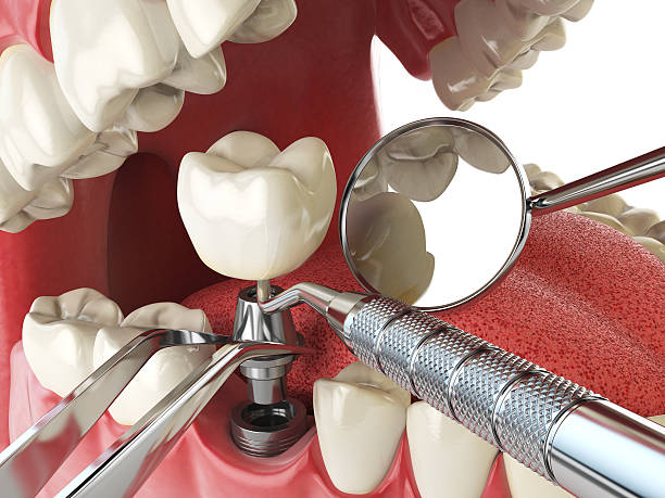 Best Emergency Dental Care for Broken or Chipped Teeth in Gulfport, FL